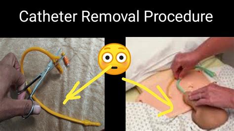 catheters for men-how do you remove catheters