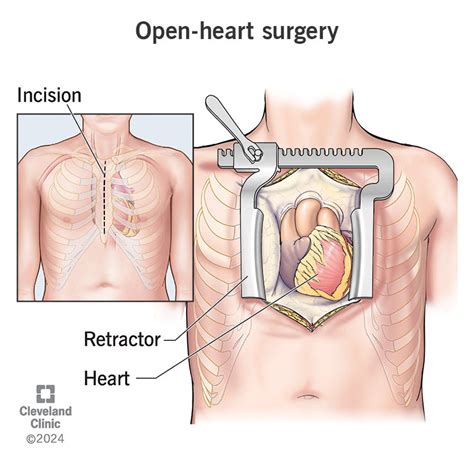 Catheters Open Heart Surgery