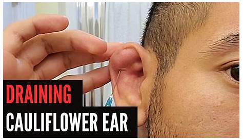 How To Drain A Cauliflower Ear Yourself: DIY Guide (BJJ)