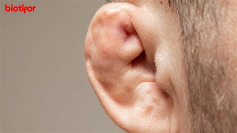 Cauliflower Ear Dangerous