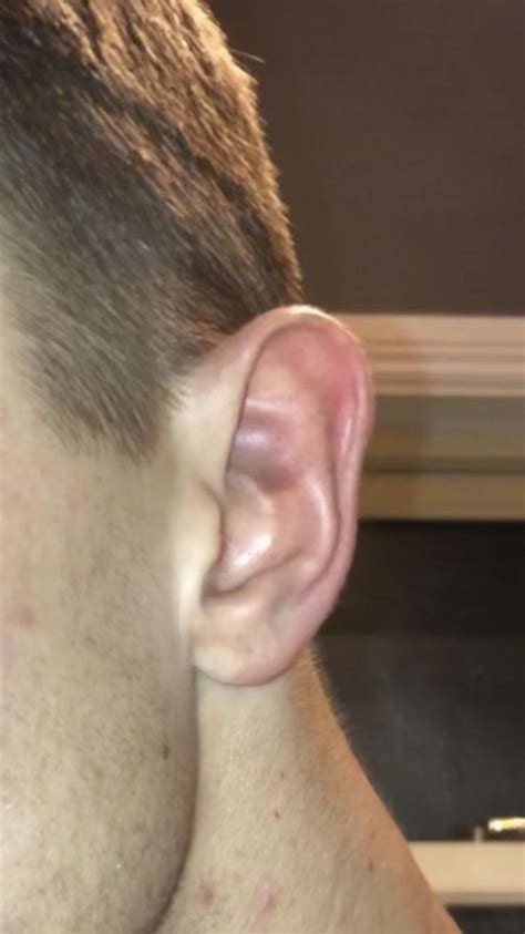 Cauliflower Ear Drain Reddit