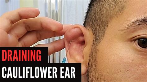 Cauliflower Ear Getting Drained