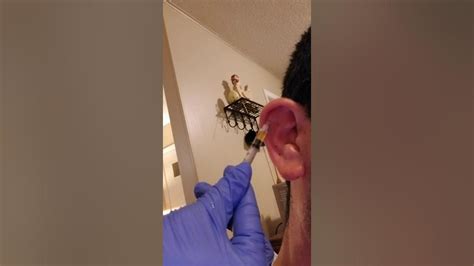 Cauliflower Ear Removal