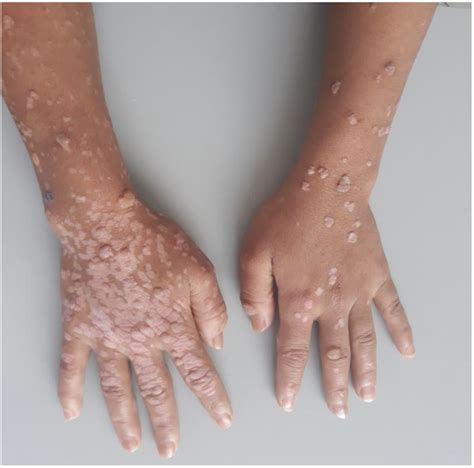 Cauliflower Hpv Warts