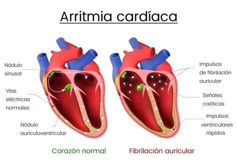 causas de arritmia ventricular