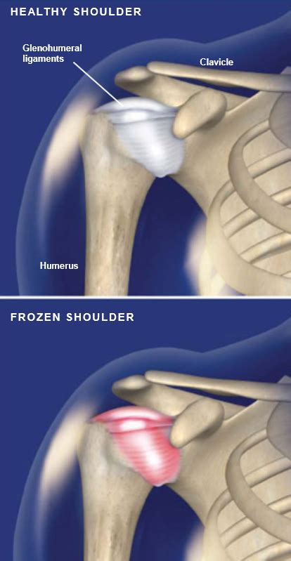 Frozen shoulder Adhesive capsulitis of the shoulder