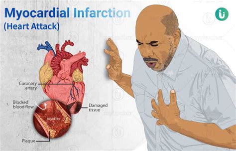Let's discuss Heart Attack Causes PoTips