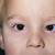 causes of strabismus pediatric