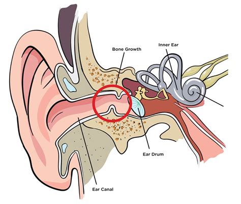 causes and symptoms of exostosis ear