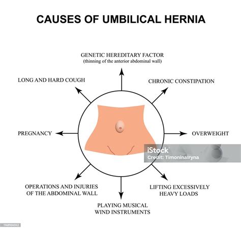 Causes de l'Hernie Ombilicale