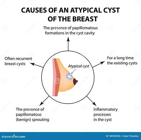 causes kyste mammaire