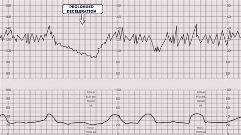 causes of deceleration in ctg