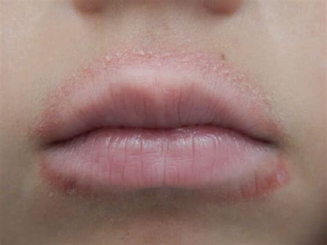 Causes Of Dry Upper Lip