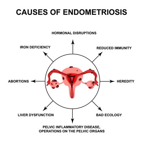 causes of endometriosis disease