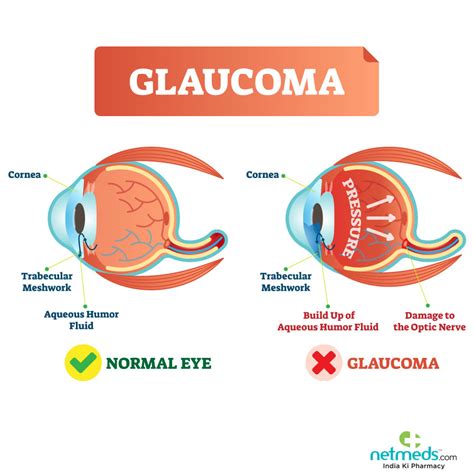 Understanding the Hidden Causes of Glaucoma: What You Need to Know