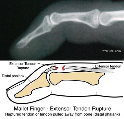 Causes Of Mallet Finger Deformity