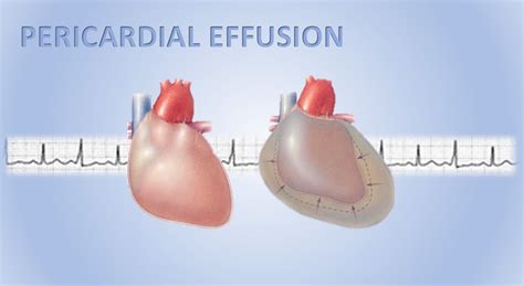 Understanding the Common Causes of Pericardial Effusion Explained