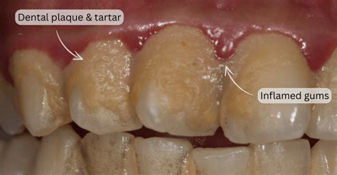 Causes Of Plaque In Teeth