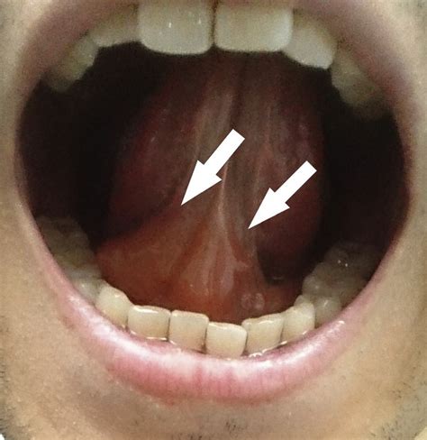 causes of swollen lingual frenulum
