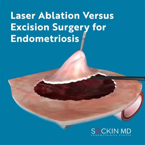 cauterization of endometrial implants