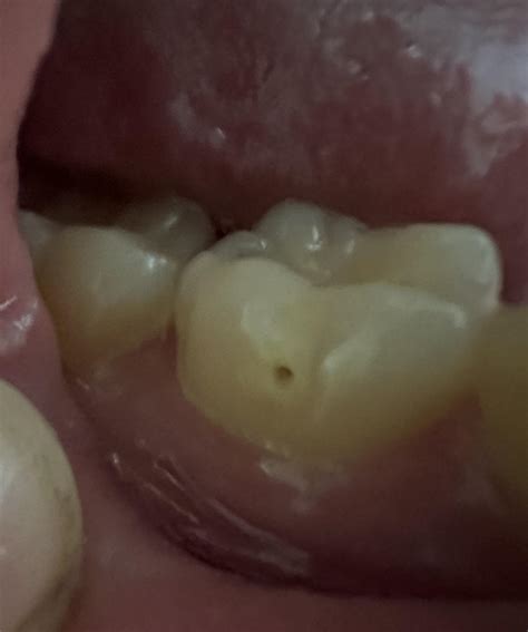 Cavity Filling Reddit