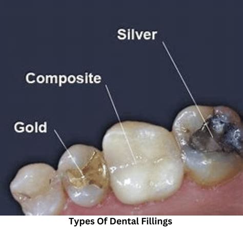 Cavity In Teeth Filling