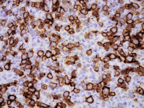 cd30 immunostain positive means what