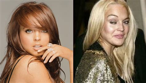 celebrity bad plastic surgery