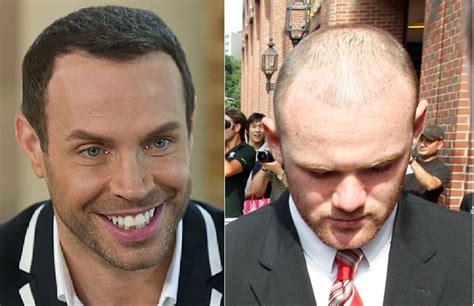 celebrity hair transplants doctors