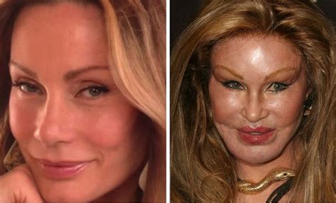 celebrity plastic surgery gone wrong