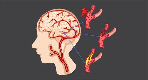 Cerebrovascular Disease Prevention and Treatment Strategies Explained Simply