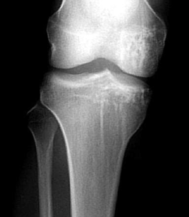 Celery Stalk Radiopaedia
