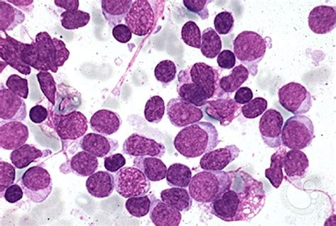 cell acute lymphoblastic leukemia