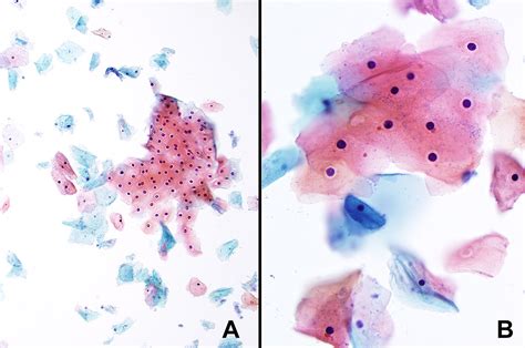 cellular changes in malignancy