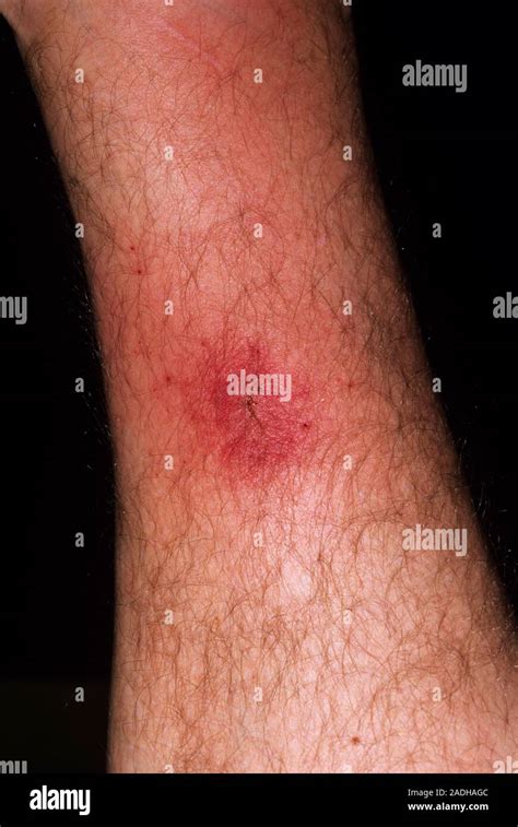 Cellulitis from Insect Bite: Causes, Symptoms, and Treatment Options