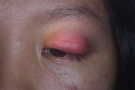 Understanding Cellulitis of the Eye: Causes, Symptoms, and Effective Treatment Options