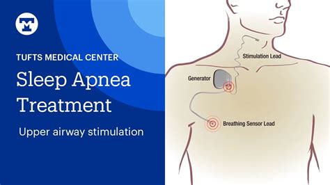center for sleep apnea