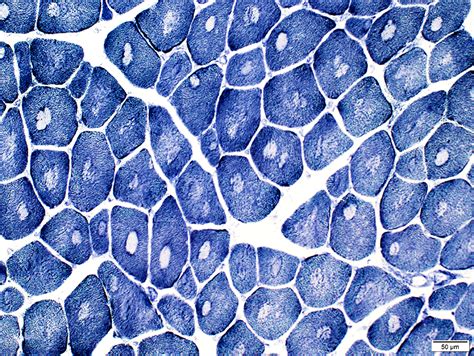 Uncovering the Mysteries of Central Core Disease: A Rare Condition