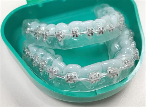 Ceramic Braces And Mri