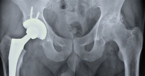 sininentuki.info:ceramic hip replacement recovery
