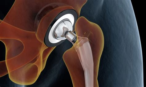 ceramic hip replacement recovery
