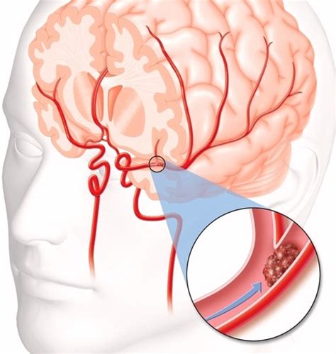 cerebral thrombosis in english
