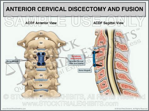cervical acdf cpt code