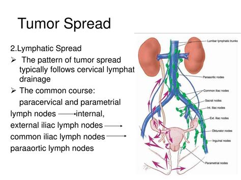 cervical cancer lymph node drainage