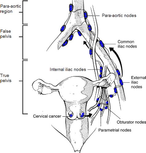 cervical cancer lymph node metastasis