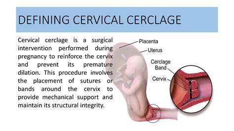 Understanding the Cervical Cerclage Procedure: A Lifesaving Measure for High-Risk Pregnancies