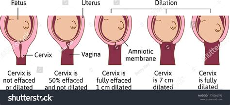 Cervical Dilation Medication