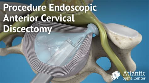 cervical endoscopic discectomy cpt code
