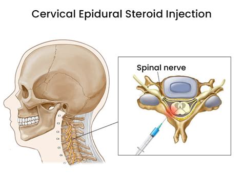 Relieve Neck Pain with Cervical Epidural Steroid Injection Treatment
