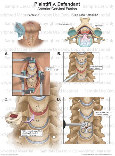 cervical fusion